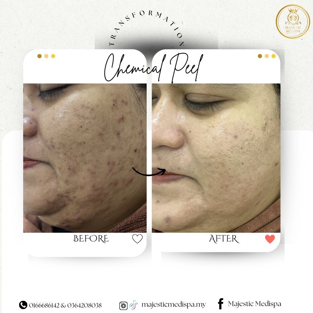 Before and after skin photo at Majestic Medispa